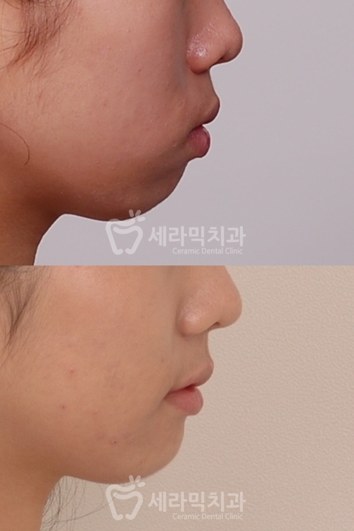 돌출입교정만 했을 뿐인데, 얼굴형과 무턱까지 개선된 치아교정전후 관련 이미지 7