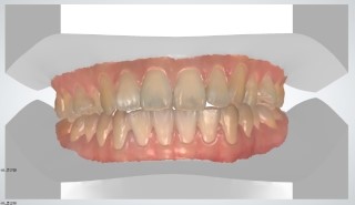 3D 스캐너를 이용한 교정 심뮬레이션 관련 이미지 8