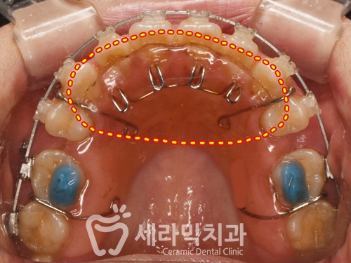 혀내밀기 습관과 개방교합, 오픈바이트(Open bite) 치아교정전후 보기 관련 이미지 7