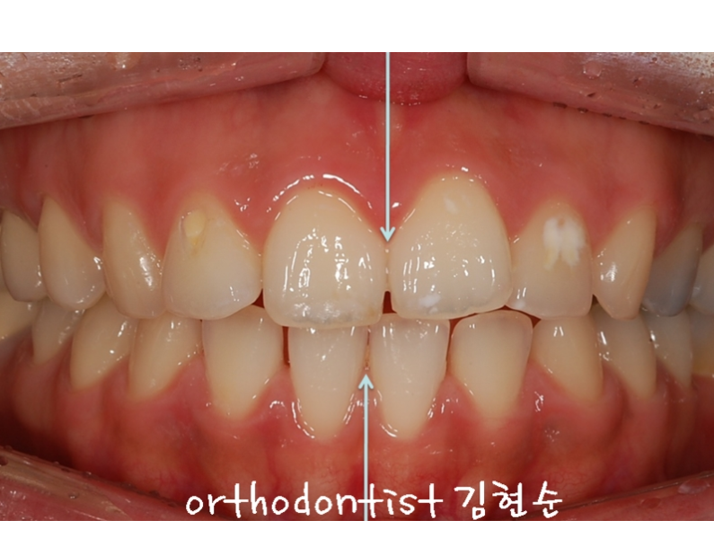 학동역치과 돌출입교정은 세라믹치과에서 관련 이미지 7
