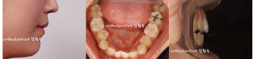 개방교합 비발치 세라믹교정 관련 이미지 8