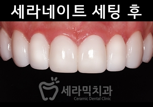 무삭제라미네이트 , 세라네이트가 궁금하다면? 관련 이미지 6