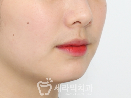 돌출입교정, 심미성과 치아 건강을 동시에 해결! 관련 이미지 23