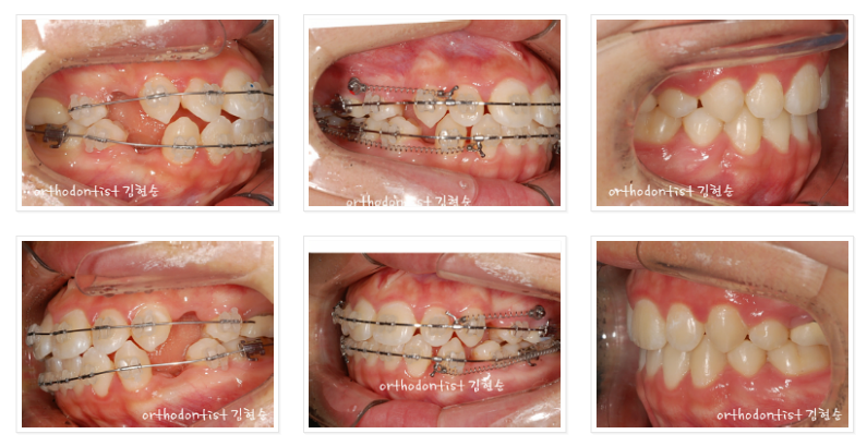 미니스크류를 이용한 발치 돌출입 교정, 무턱 개선 관련 이미지 7