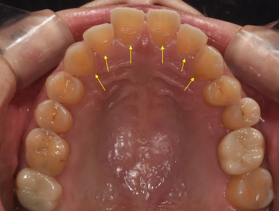 학동역 라미네이트 전후, 치아 모양과 색상 개선 사례 관련 이미지 7