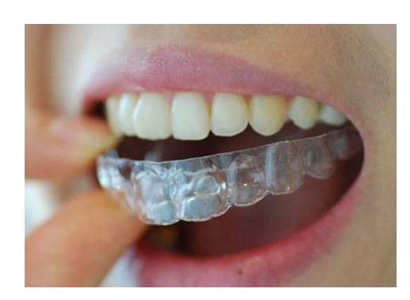 세라믹치과 교정유지장치 종류 관련 이미지 4