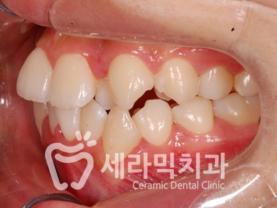 토끼이빨, 틀어진 치아배열 세라믹교정 전후사진 관련 이미지 9