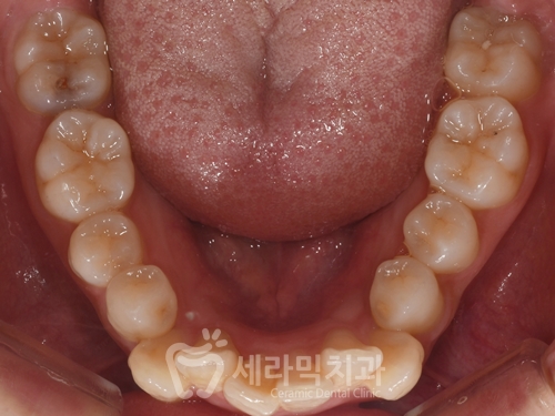 Before and After Orthodontic Treatment for Protruding Mouth and Deep Bite: A Calmer, More Sophisticated Transformation! image 7