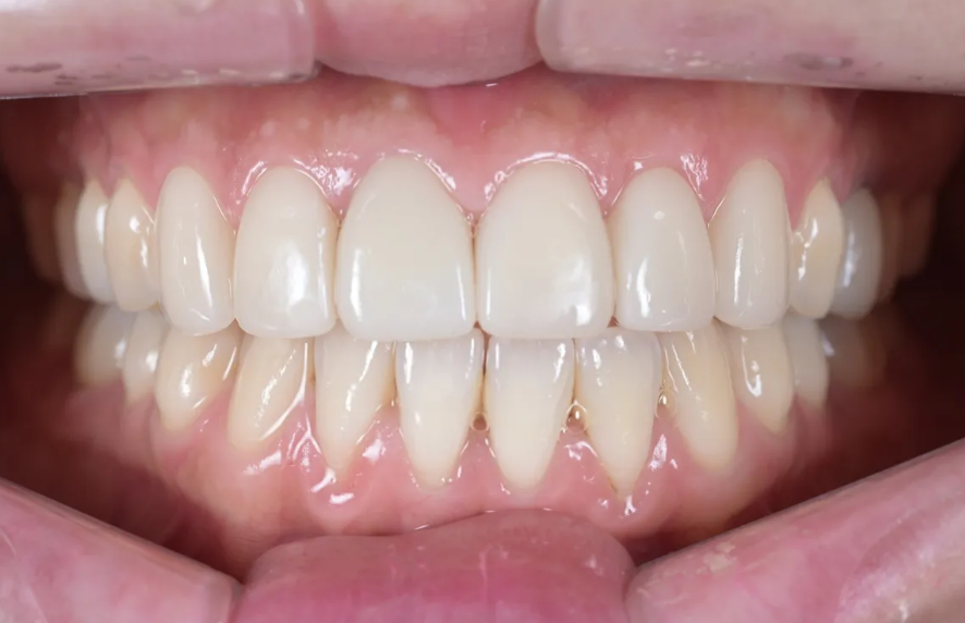 A Case of Improving the Smile Line Along with Replacing a Front Tooth Crown image 7