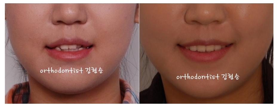 세라믹교정 은 관련 이미지 10