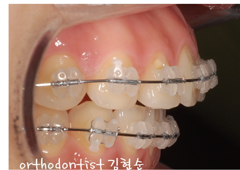 학동역치과 돌출입교정은 세라믹치과에서 관련 이미지 8