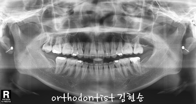 강남 돌출 관련 이미지 35