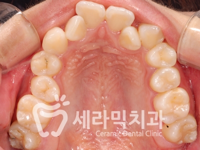 토끼이빨, 틀어진 치아배열 세라믹교정 전후사진 관련 이미지 12