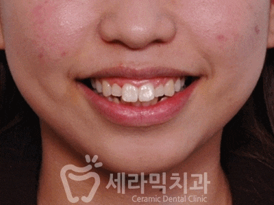 잇몸노출, 돌출입 치아교정잘하는곳, 치아교정 전후 관련 이미지 1