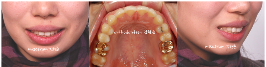 발치 돌출입교정으로 인상개선, 동안 만들기 관련 이미지 3