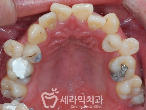 삐뚤빼뚤 틀어지고 불규칙한 치아배열 치아교정전후 관련 이미지 3