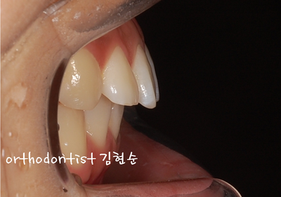 돌출 교정 (비발치 교정/비대칭) 관련 이미지 4