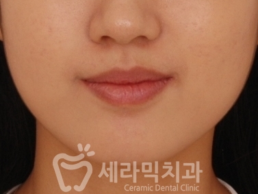 앞니 돌출, 나비치아를 남몰래 해결한 치아교정 전후! 관련 이미지 4