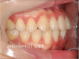 강남 돌출입 교정 관련 이미지 5