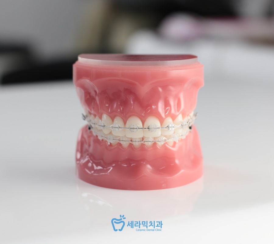 세라믹교정, 모르겠다면 이곳을 클릭 관련 이미지 3