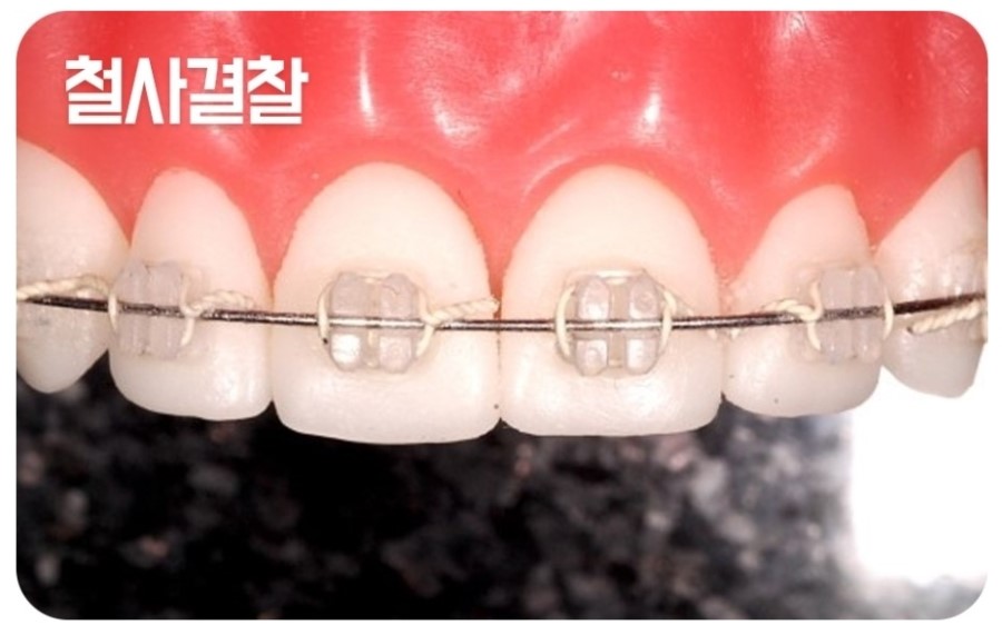 세라믹교정 클리피씨 데이몬 차이점 요약 관련 이미지 3