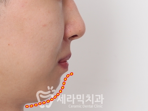 과개교합과 돌출입 개선으로 달라진 인상, 세라믹치과 치아교정전후! 관련 이미지 4