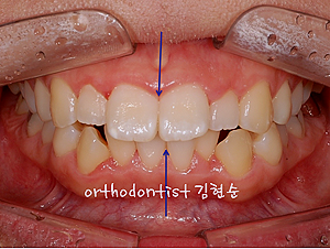 강남 돌출입 교정 관련 이미지 7