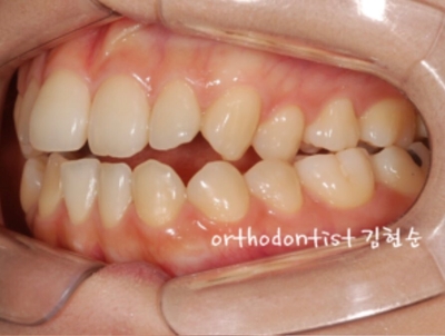 강남교정치과 관련 이미지 7