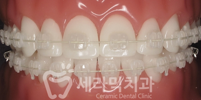 벌어진 앞니, 치아 사이 공간 교정 잘하는 세라믹치과 관련 이미지 3