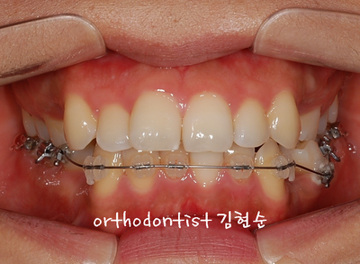 강남 돌출 관련 이미지 16