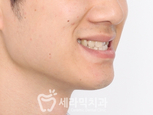 세라믹치과 치아교정전후 : 앞니반대교합+치열불규칙 관련 이미지 7