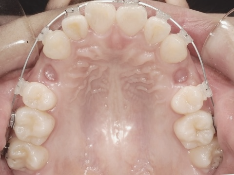 학동역치과 하면 세라믹교정 ~ 관련 이미지 18