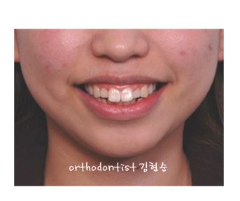 세라믹치과 "돌출입 발치교정" 관련 이미지 1
