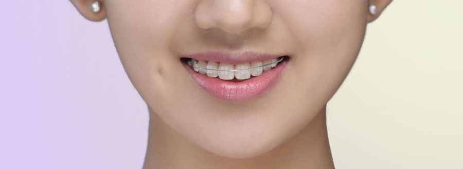 세라믹교정 세라믹치과 - 인터뷰교정 솔직 단백 후기 관련 이미지 1