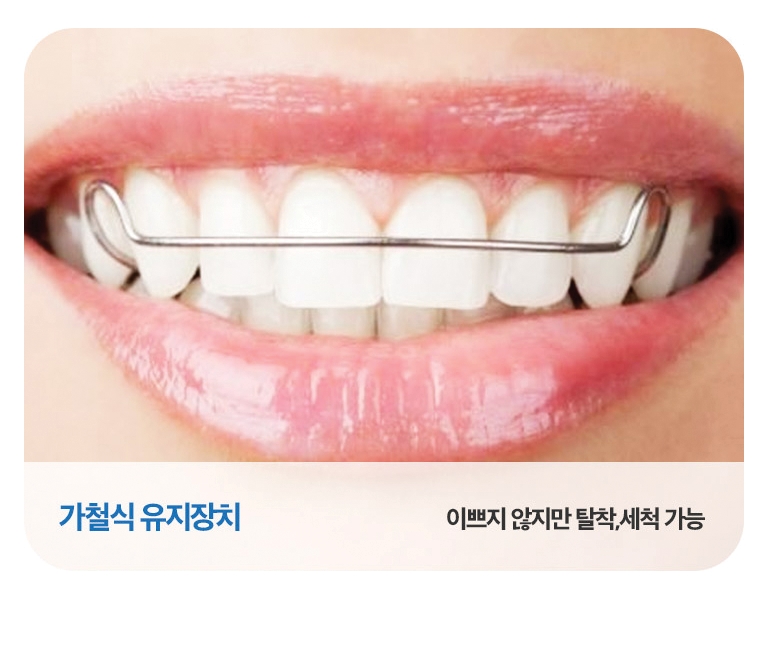 치아교정 유지장치로 부작용 예방을! 관련 이미지 4