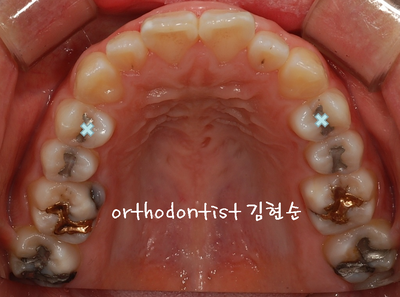 강남 돌출 관련 이미지 14