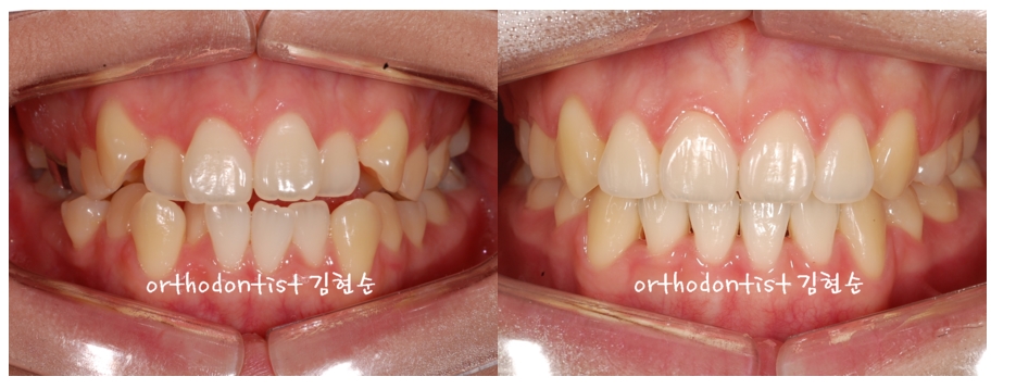 세라믹교정 은 관련 이미지 9