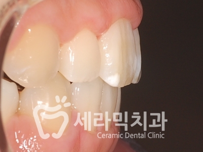 돌출입 잇몸노출 치아교정 전후 인상변화 사례 관련 이미지 17