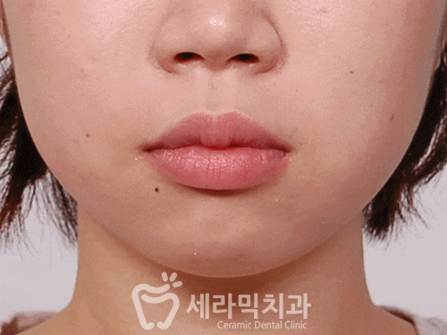 깨진 후에 후회하는 돌출입, 치아교정으로 건강하고 가지런한 치아만들기 관련 이미지 8
