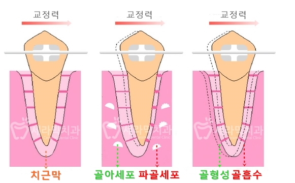 40대에 이어 50대 치아교정 전후사례 증가 추세 관련 이미지 7