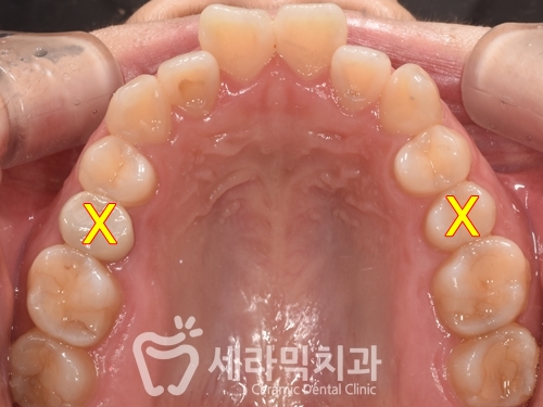 혀내밀기 습관과 개방교합, 오픈바이트(Open bite) 치아교정전후 보기 관련 이미지 8