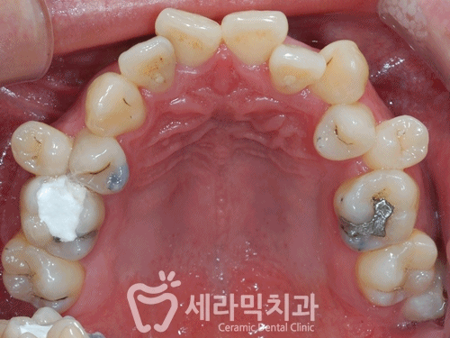 삐뚤빼뚤 틀어지고 불규칙한 치아배열 치아교정전후 관련 이미지 4