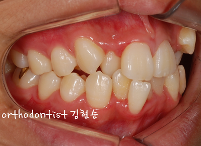 강남 덧니 관련 이미지 5