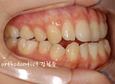 개방 교합 관련 이미지 9