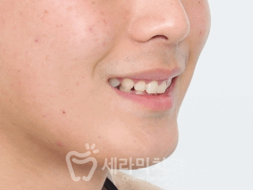 과개교합, 거미스마일, 치아 벌어짐까지 한번에! 치아교정전후 살펴보기 관련 이미지 8