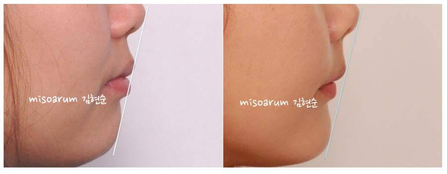 발치 교정으로 덧니 치열 올바로 잡기 관련 이미지 11