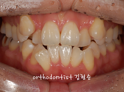 강남 덧니 관련 이미지 5