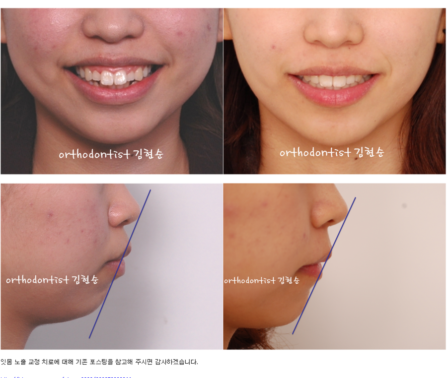 세라믹교정 세라믹치과-돌출입발치교정 5 관련 이미지 7