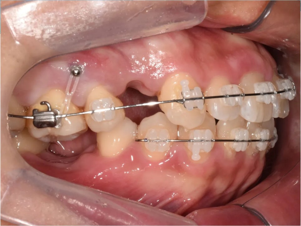 돌출입 교정 전후, 그런데 과개교합까지 있으셨던 환자분 관련 이미지 13