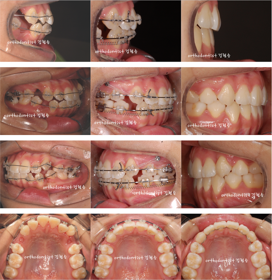 세라믹교정 세라믹치과-돌출입발치교정 4 관련 이미지 3